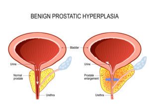 Benign prostatic hyperplasia (BPH). prostate enlargement