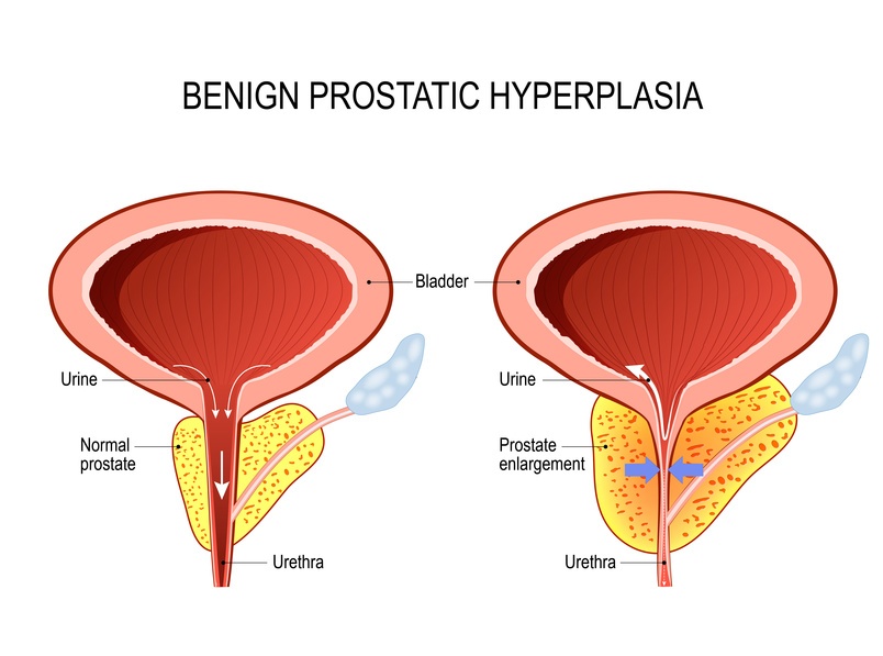  Benign prostatic hyperplasia (BPH). prostate enlargement